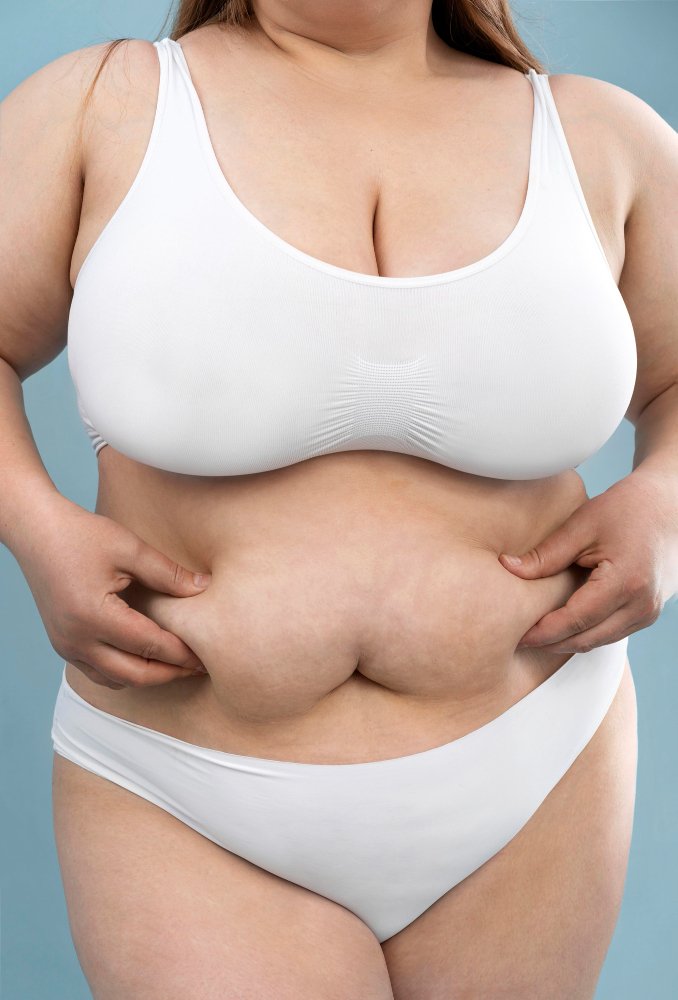 Mommy Makeover в Турции — результат до и после в Cayra Clinic