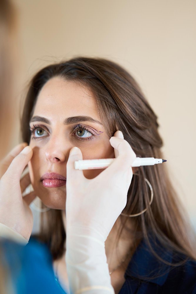 Разрез и рубец блефаропластики верхних век в клинике Cayra Clinic