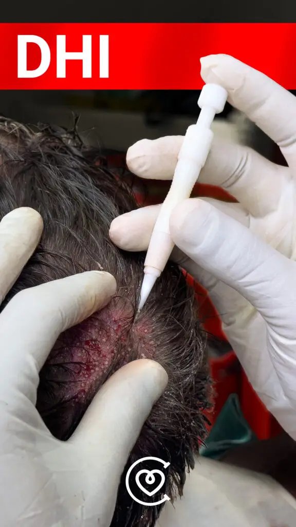 пересадка волос DHI