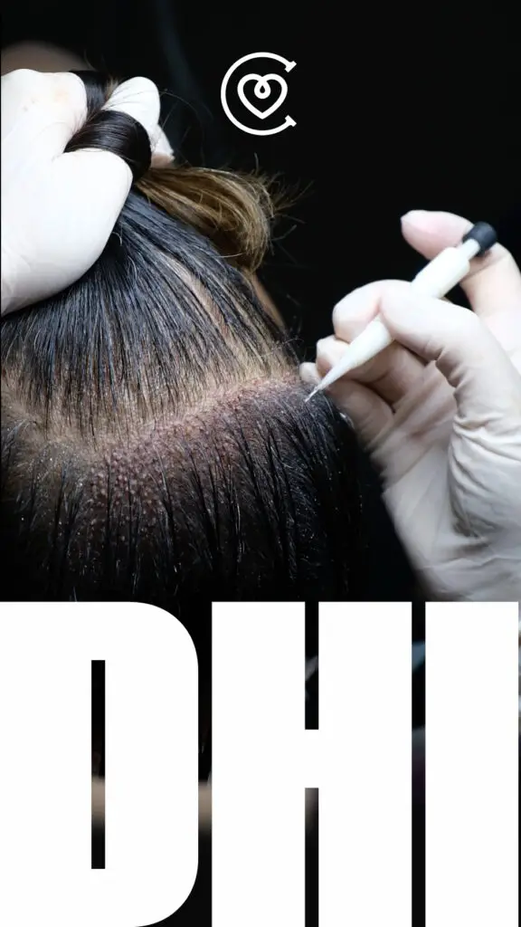 пересадки волос методом DHI