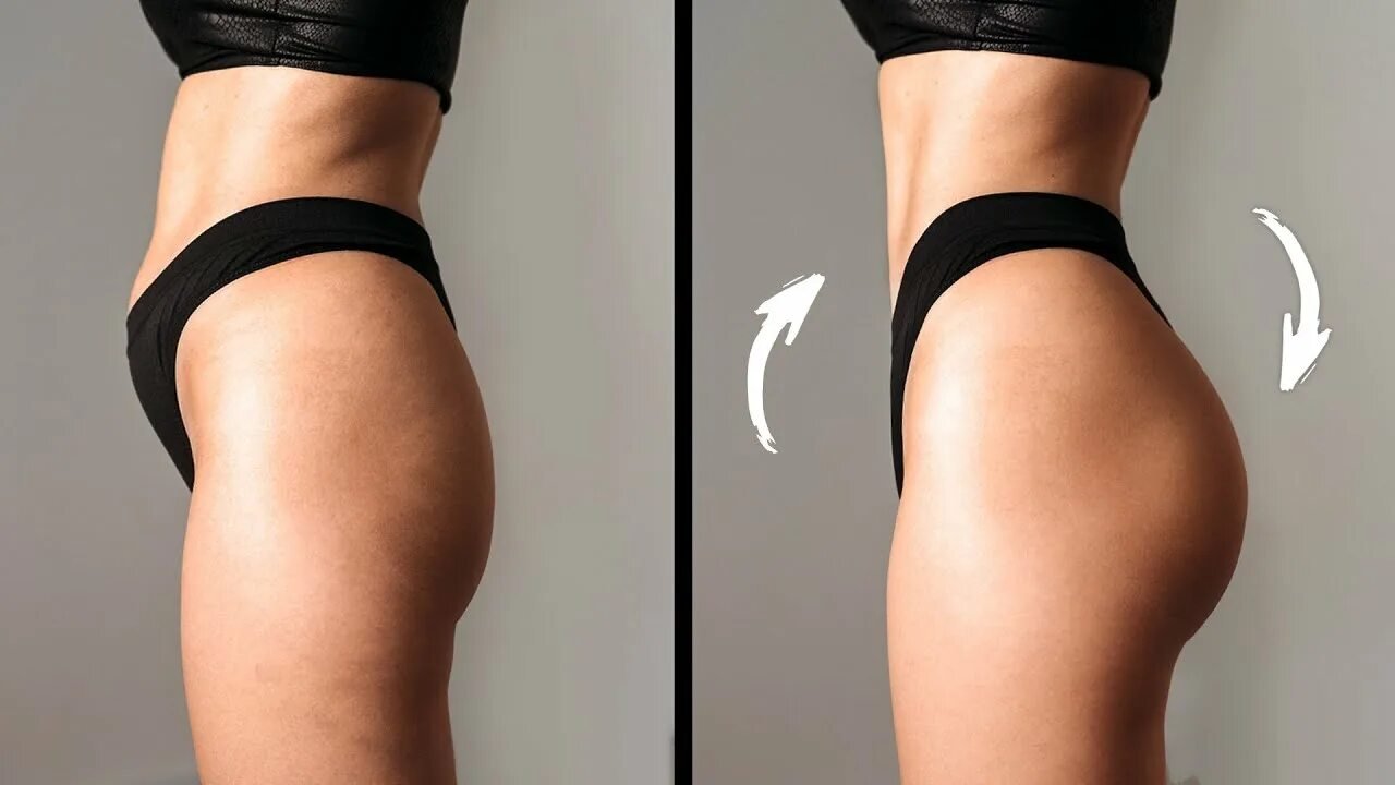 Увеличение ягодиц до и после — результат в клинике Cayra Clinic Анталья
