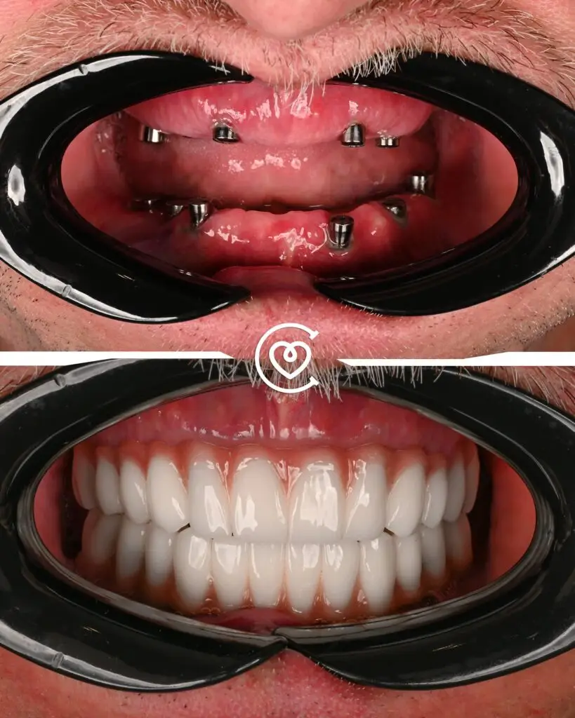 имплантация All-on-4 в Турции