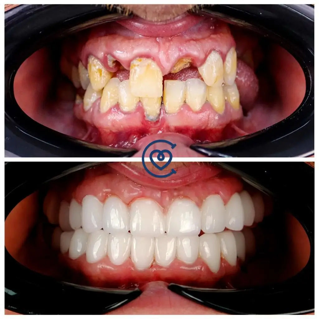 коронки до и после