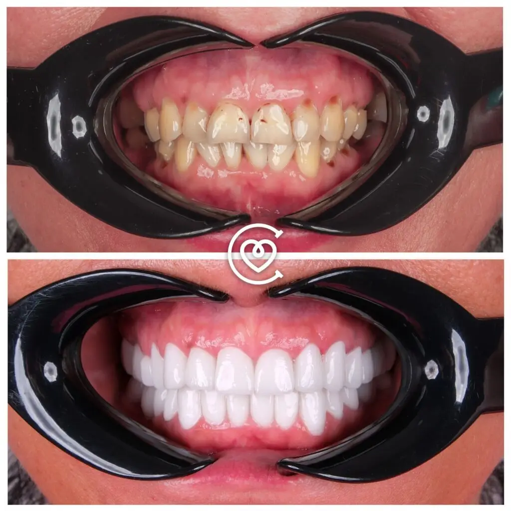 преимущества виниров