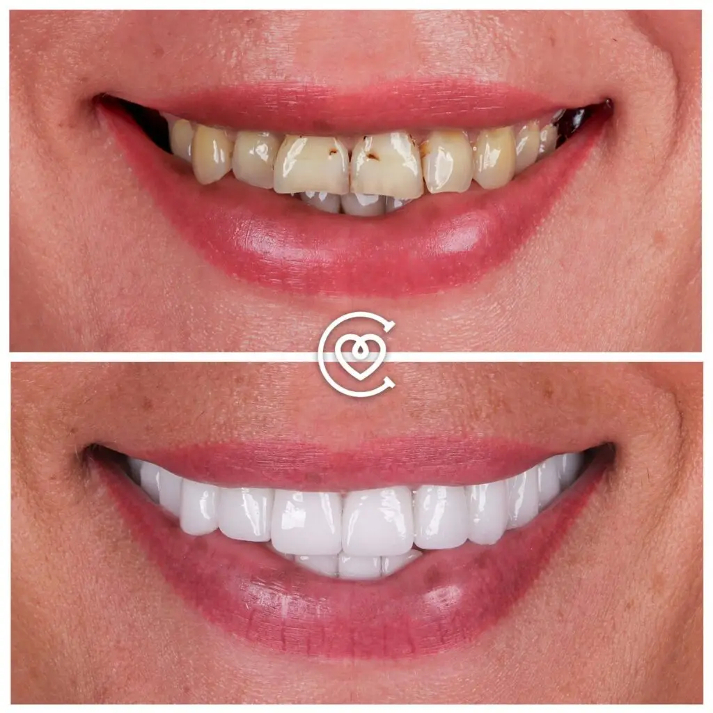 стоматология Турция результаты