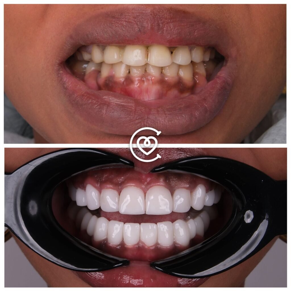 эстетическая стоматология Турция