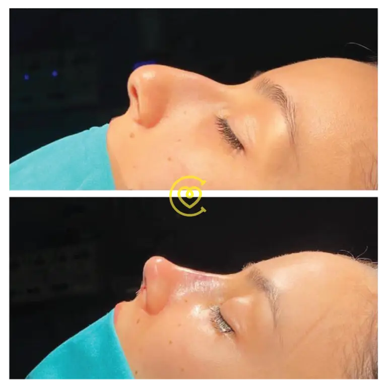 Аларпластика vs. Ринопластика