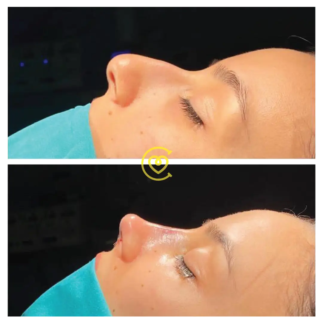 Аларпластика vs. Ринопластика