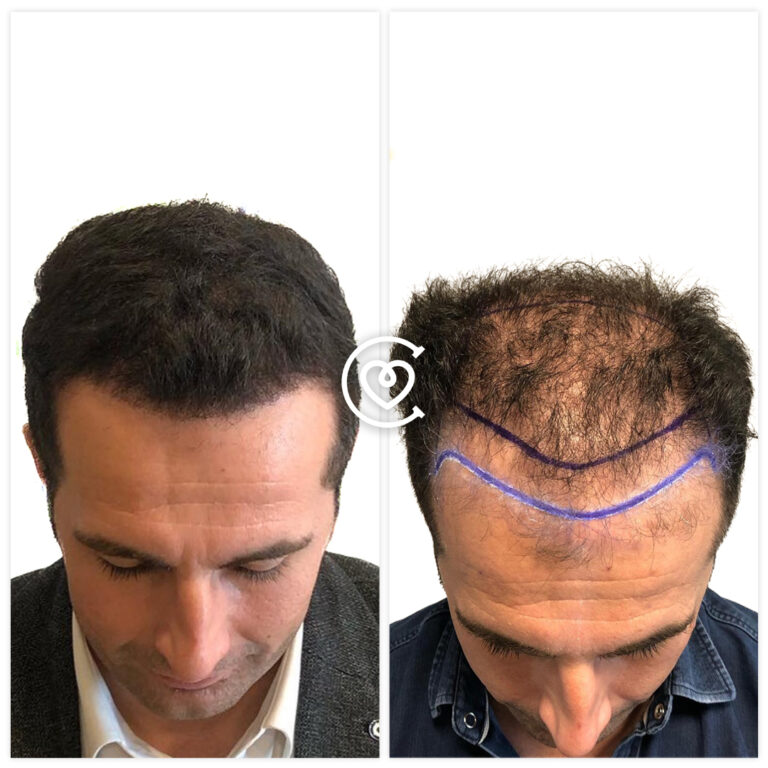 Отзывы о Пересадке Волос