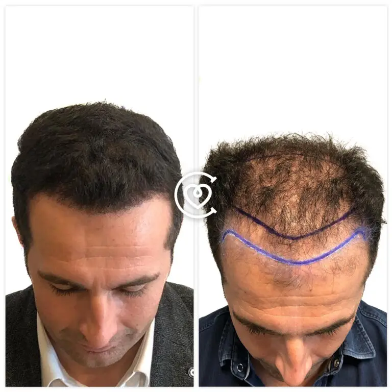 Отзывы о Пересадке Волос