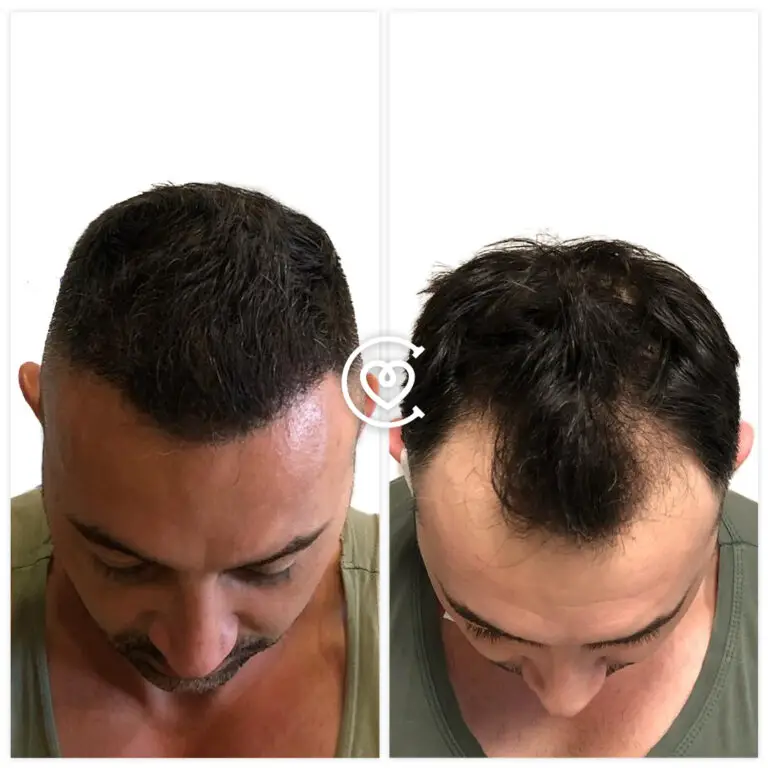 Отзывы о Пересадке Волос