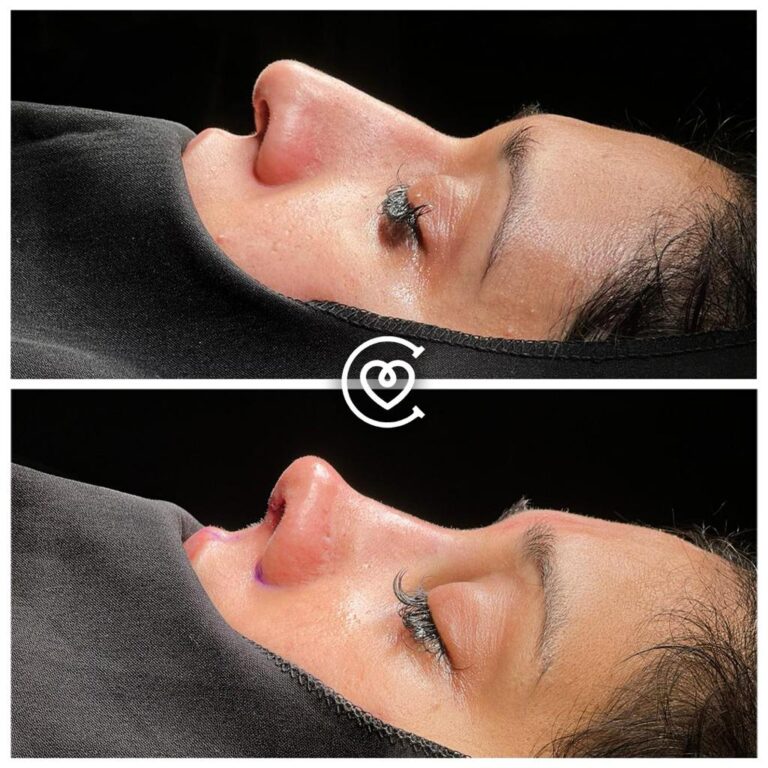 Отзывы о Ринопластике