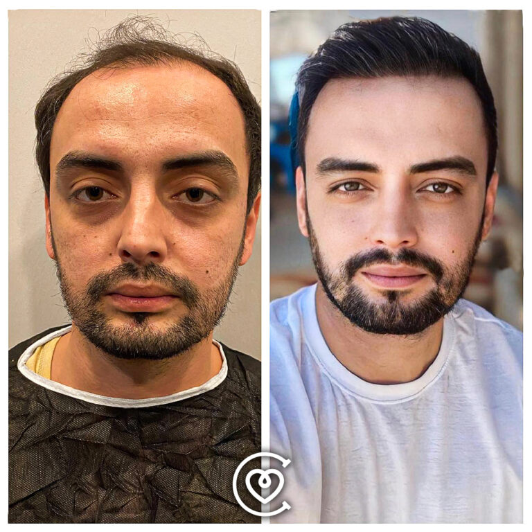 Отзывы о Пересадке Волос