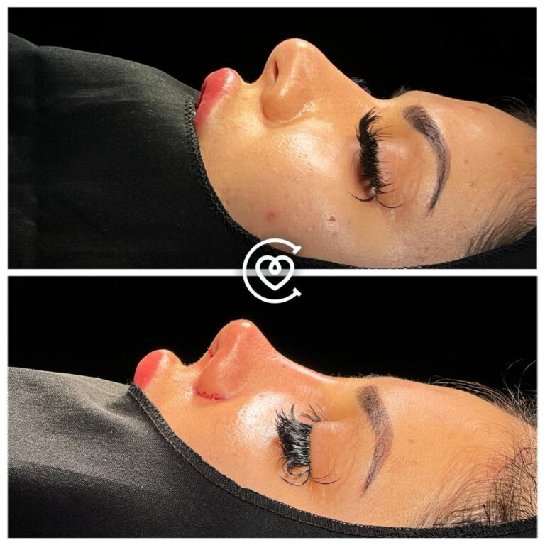 Ринопластике