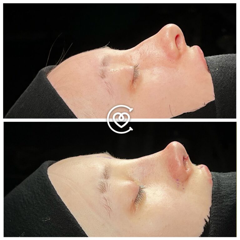 Отзывы о Коррекции Носа