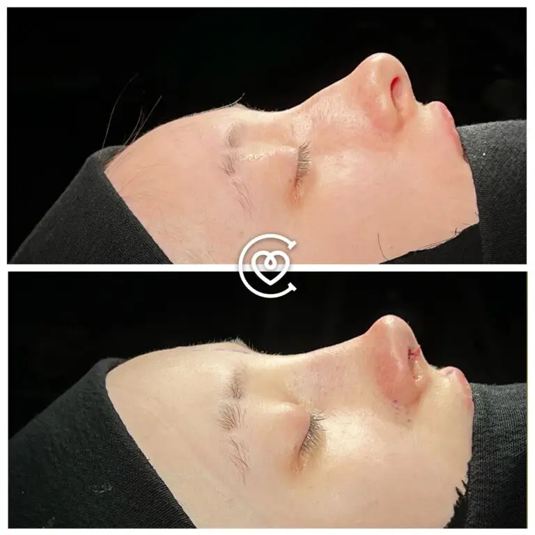 Отзывы о Коррекции Носа