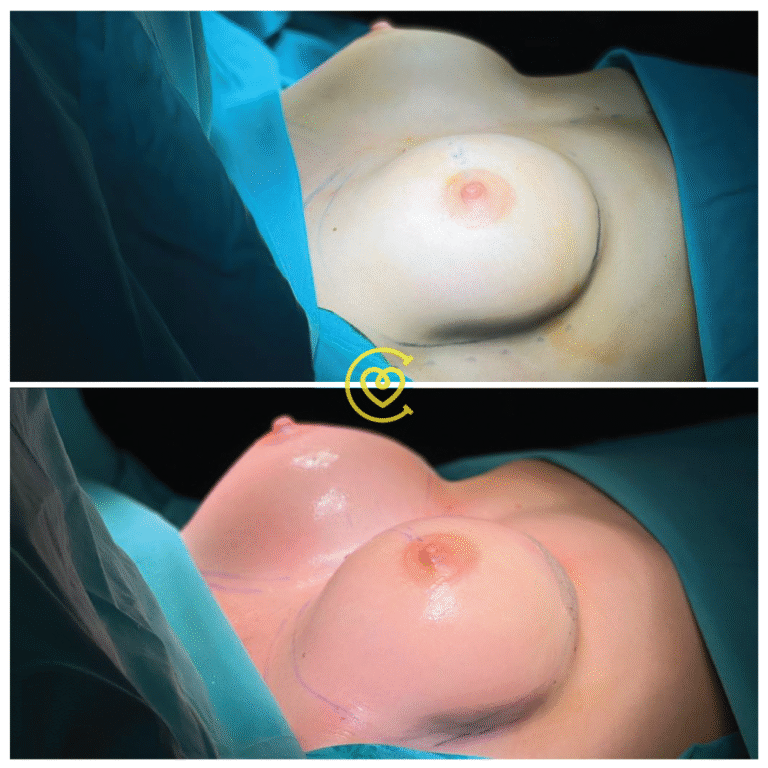 Пластика Груди