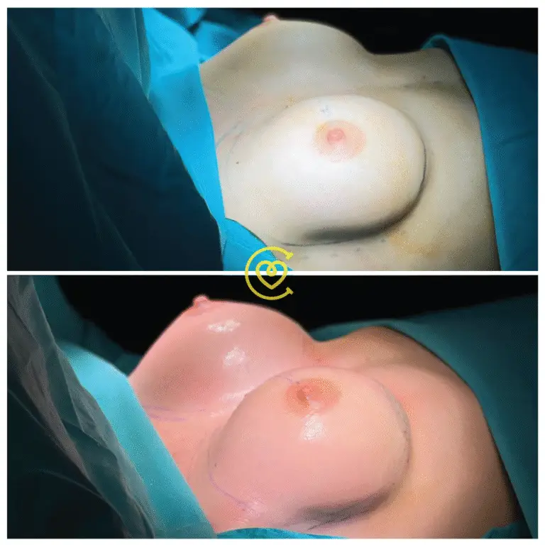 Пластика Груди