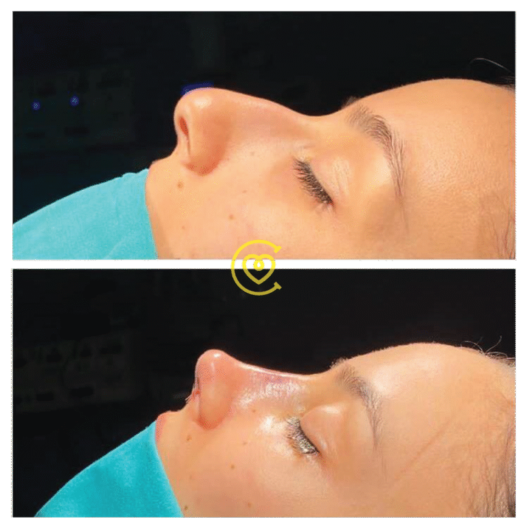 Отзывы Пациентов о Ринопластике