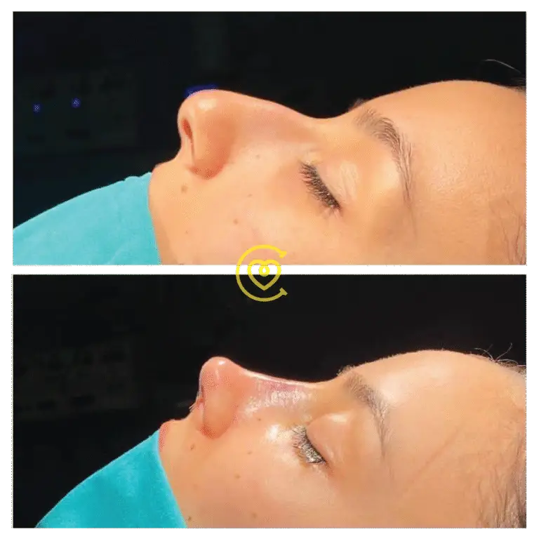 Отзывы Пациентов о Ринопластике