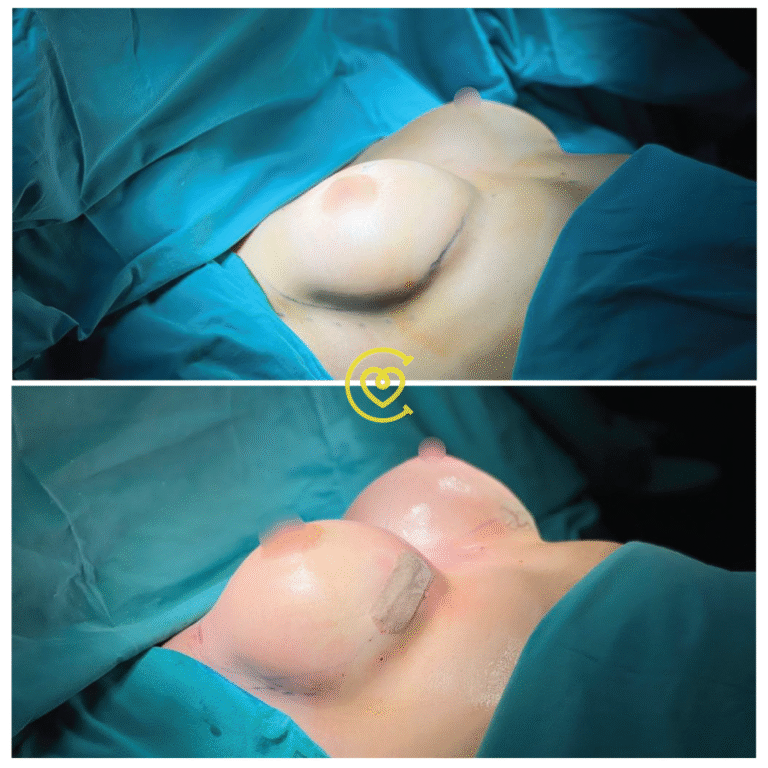 Эстетических Операций на Груди