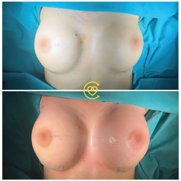 Эстетических Операций на Груди