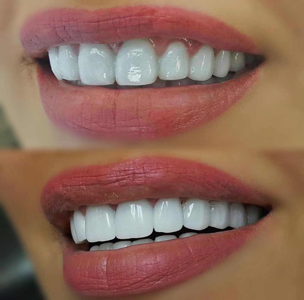 Виниры из Турции Почему Всё Больше Людей Едут За Улыбкой Именно Сюда