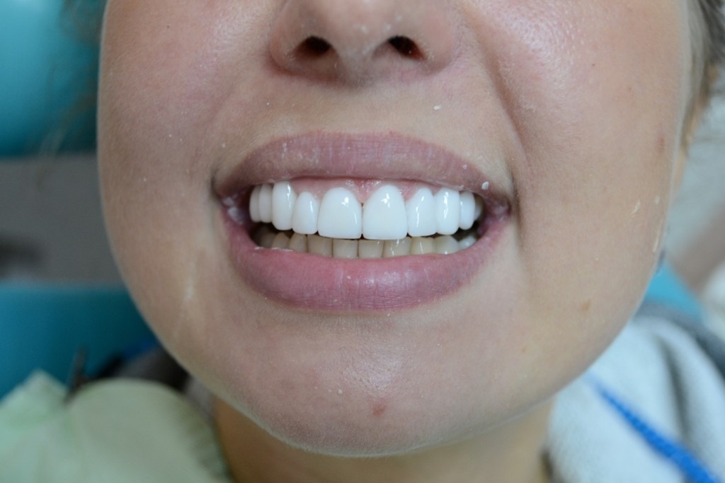 Виниры из Турции Почему Всё Больше Людей Едут За Улыбкой Именно Сюда