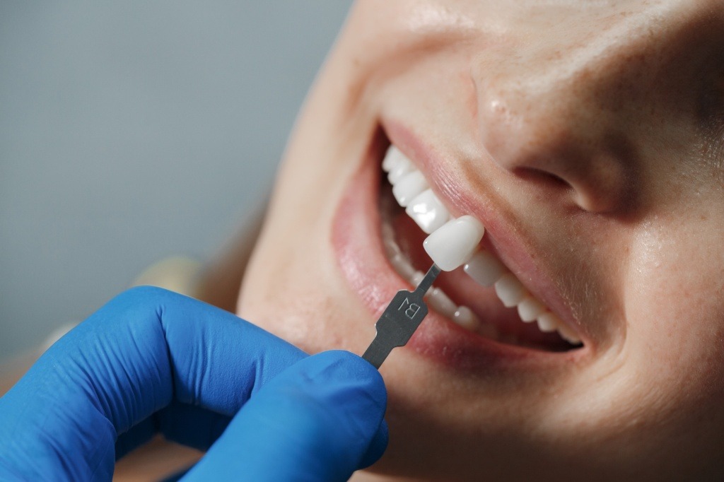 Виниры из Турции Почему Всё Больше Людей Едут За Улыбкой Именно Сюда