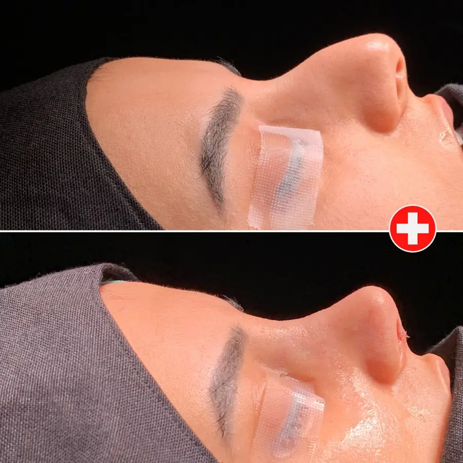 повторную ринопластику