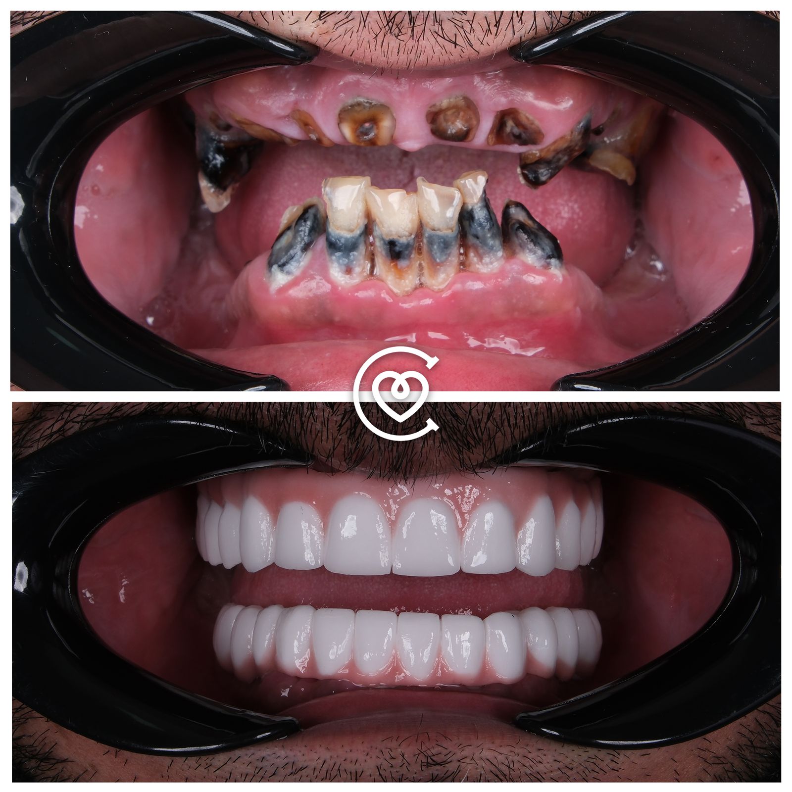 Голливудская Улыбка в Турции