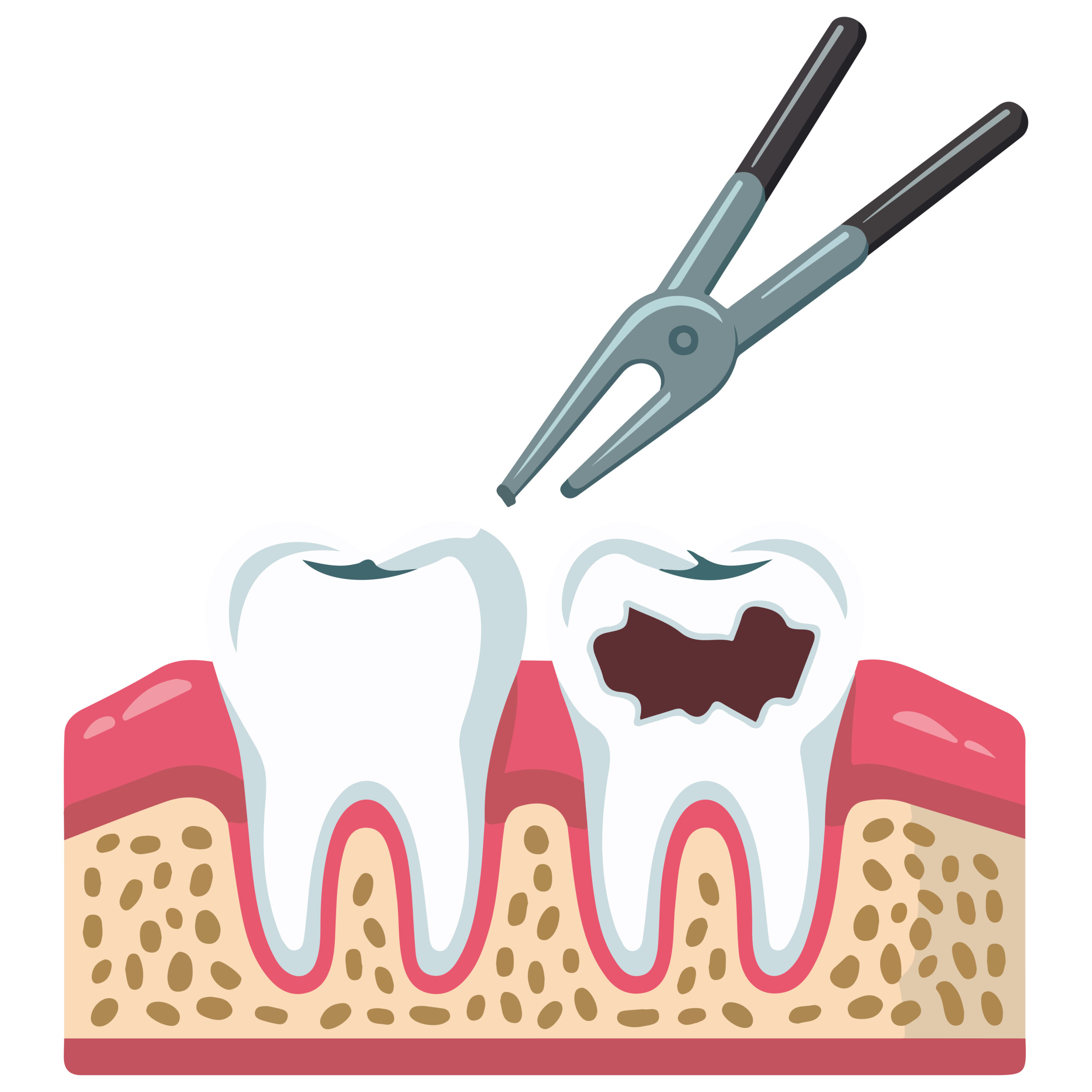 Удаление Зубов Мудрости и Другие Процедуры в Турции