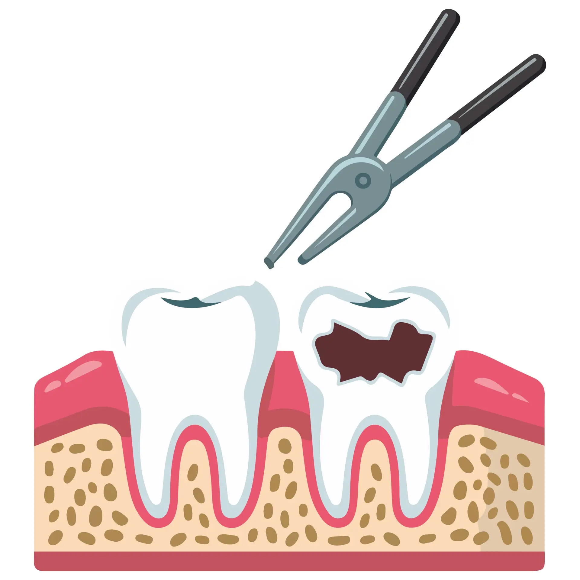 Удаление Зубов Мудрости и Другие Процедуры в Турции