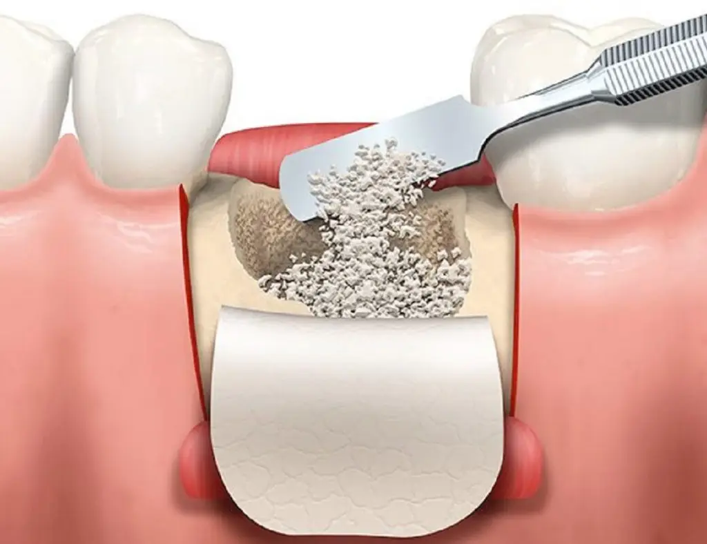 костная пластика для имплантации зубов