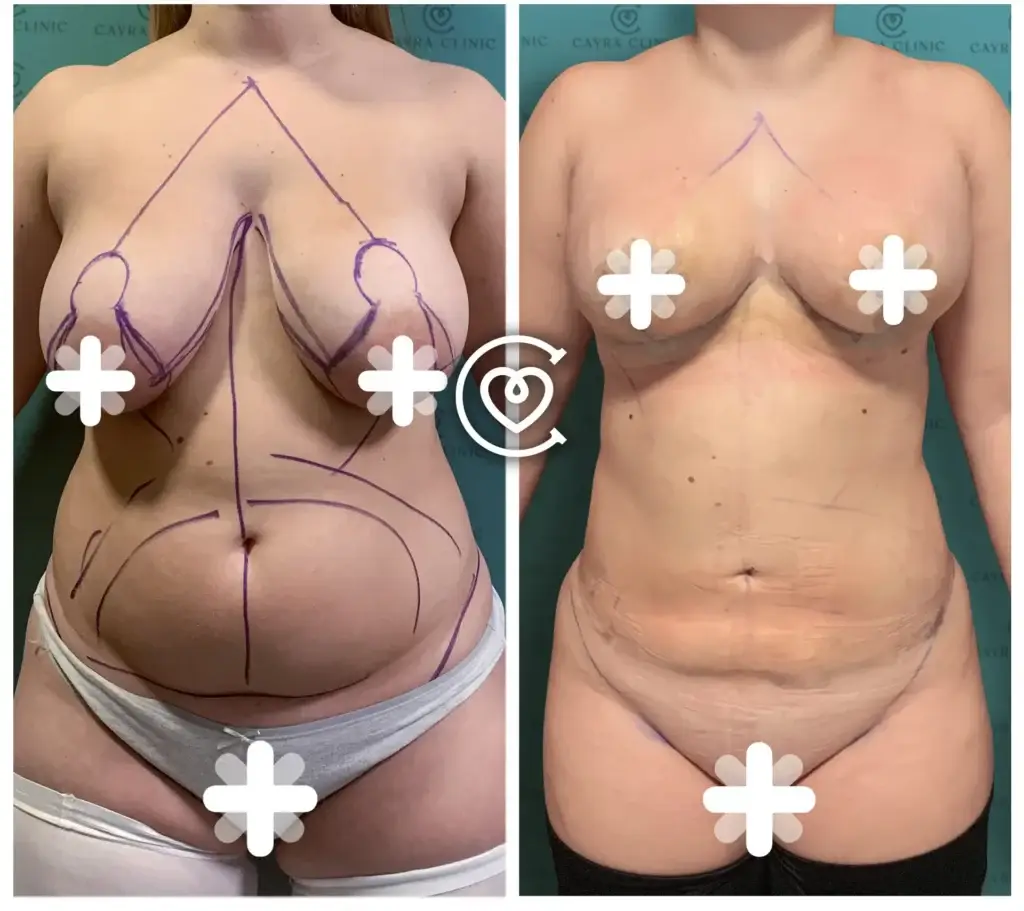 Фотографии до и после подтяжки живота