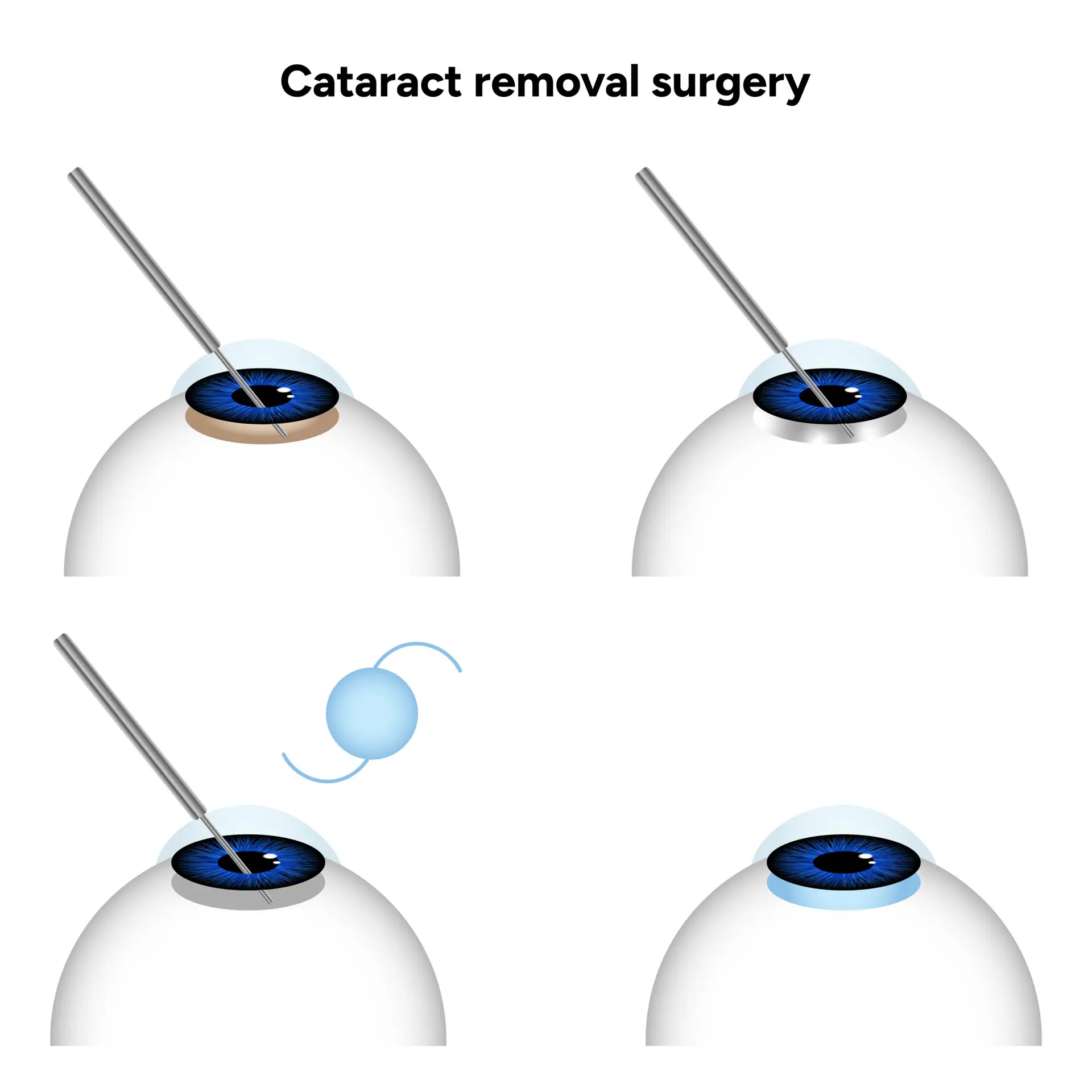 Хирургия Катаракты