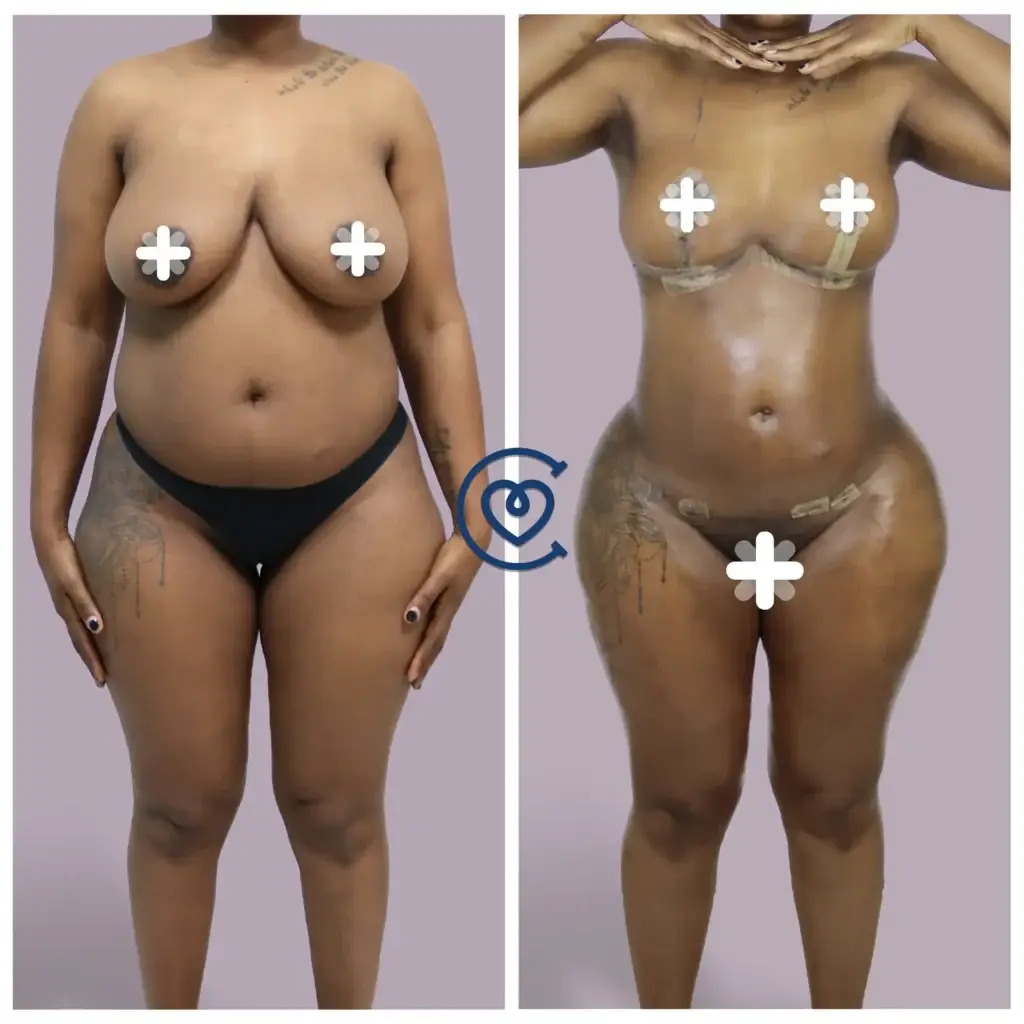 липосакция, BBL, фото до и после