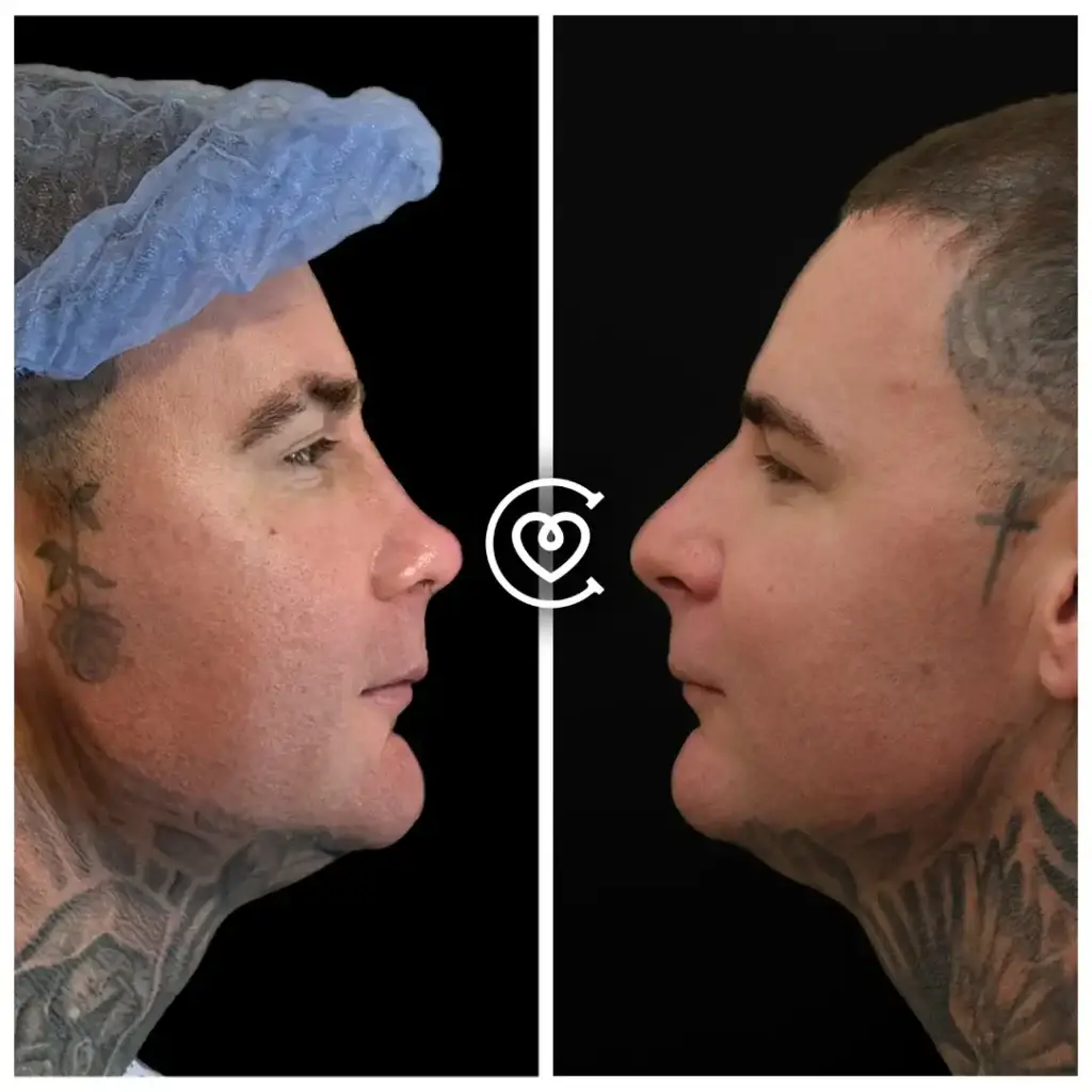 ринопластика до и после фото