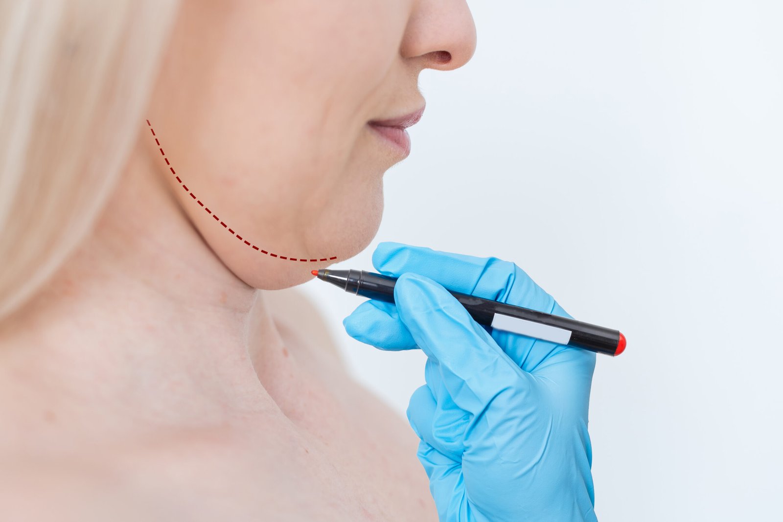 Компьютерное 3D-моделирование контуров профиля лица перед ментопластикой в Cayra Clinic Стамбул