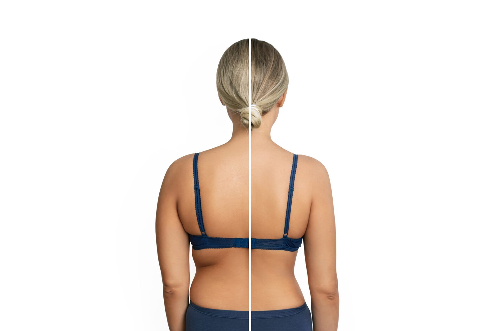 Back Lift подтяжка спины после похудения в клинике Cayra Clinic