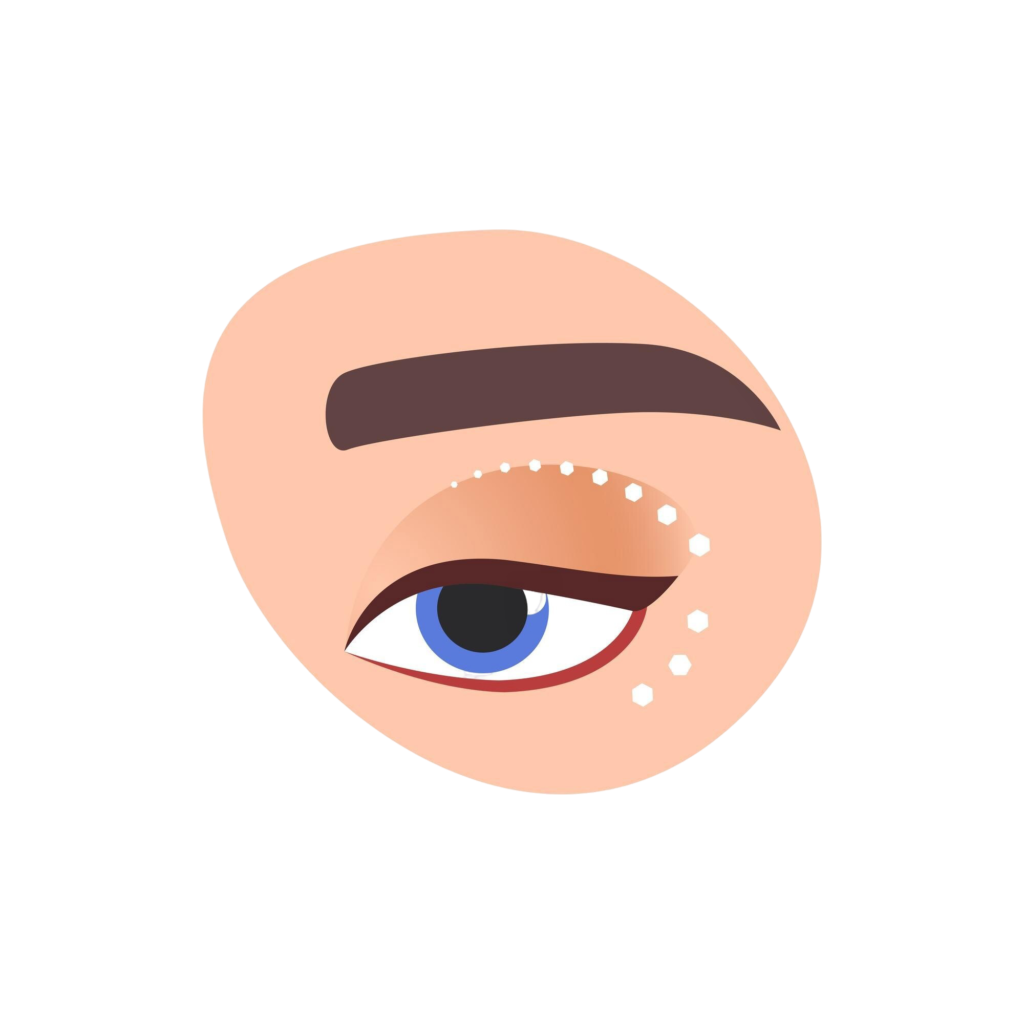 Блефаропластика нижних век в клинике Cayra Clinic Турция