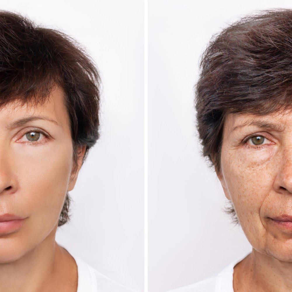 Эндоскопическая подтяжка лица в клинике Cayra Clinic Анталья