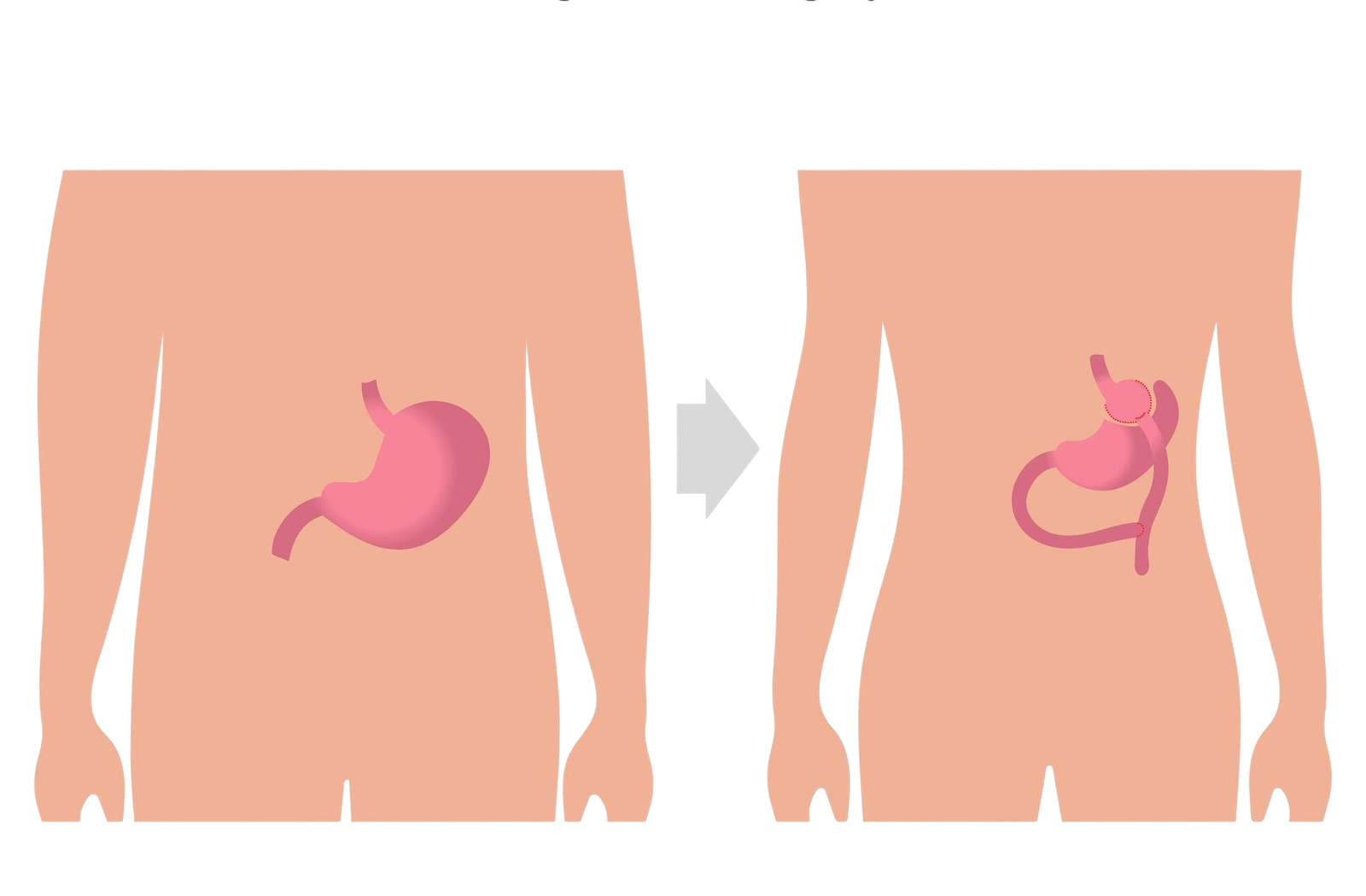 Бариатрический хирург клиники Cayra Clinic консультирует по операциям в Анталье
