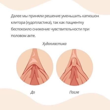 Худопластика в Турции