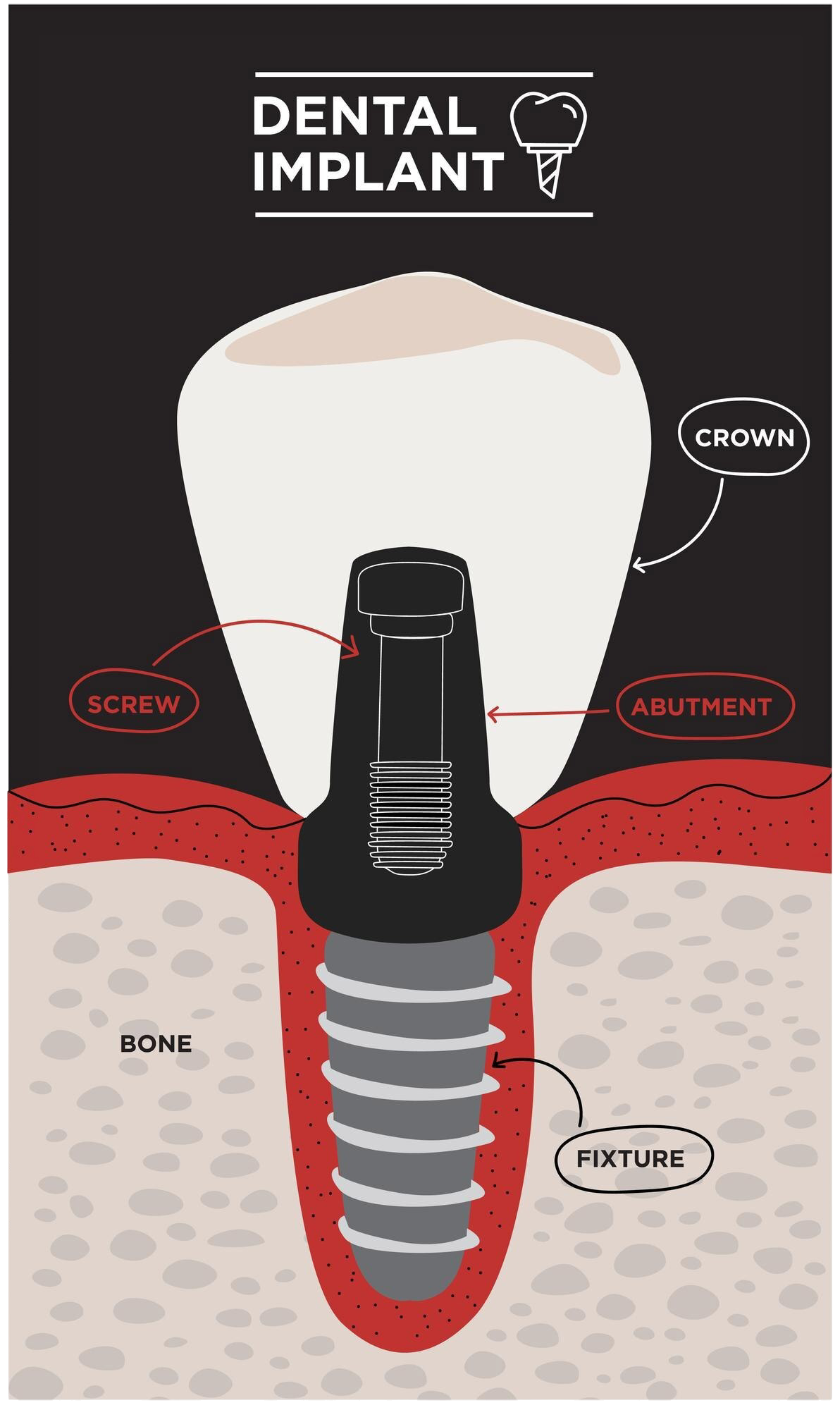 implantaciya-all-on-6