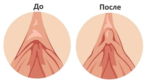 Худопластика