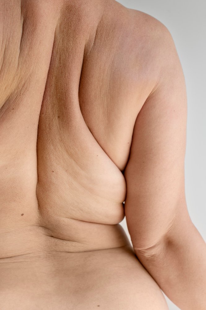Лазерная липосакция SmartLipo в Турции