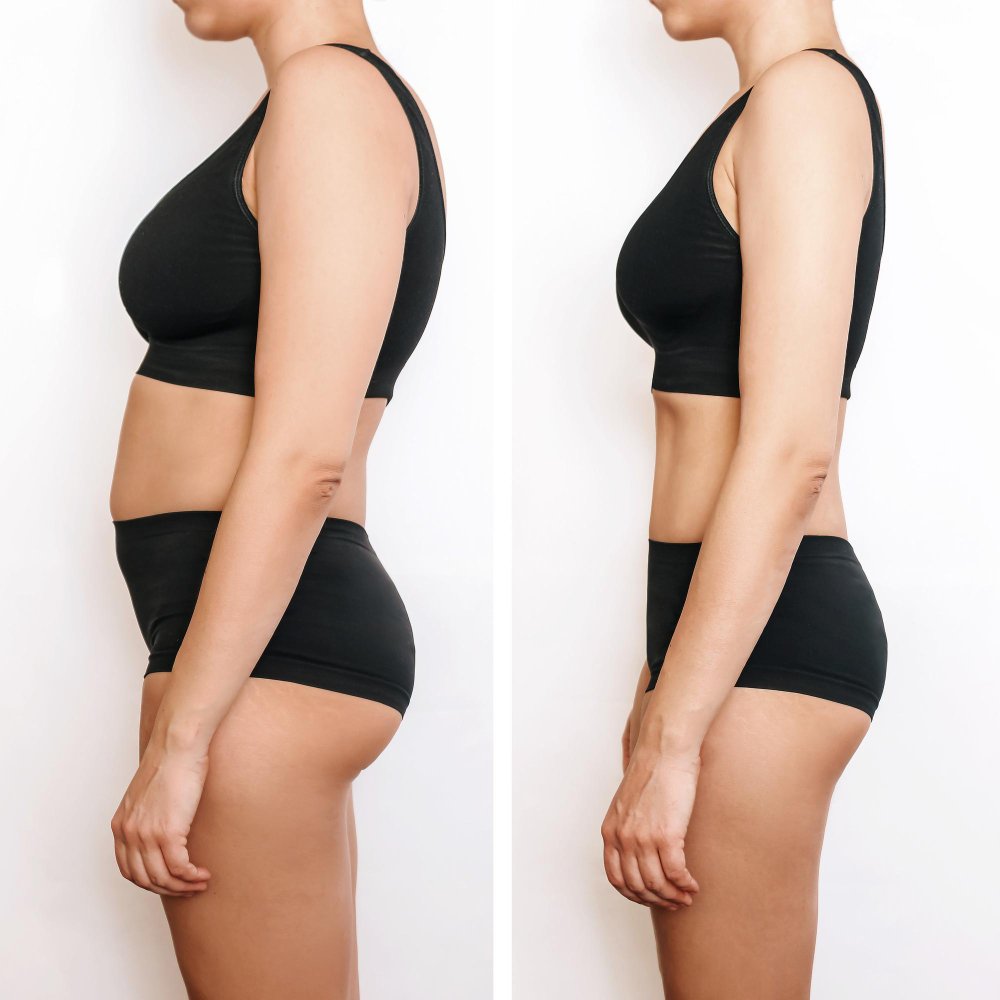 360-градусная липосакция и Abdominal Etching