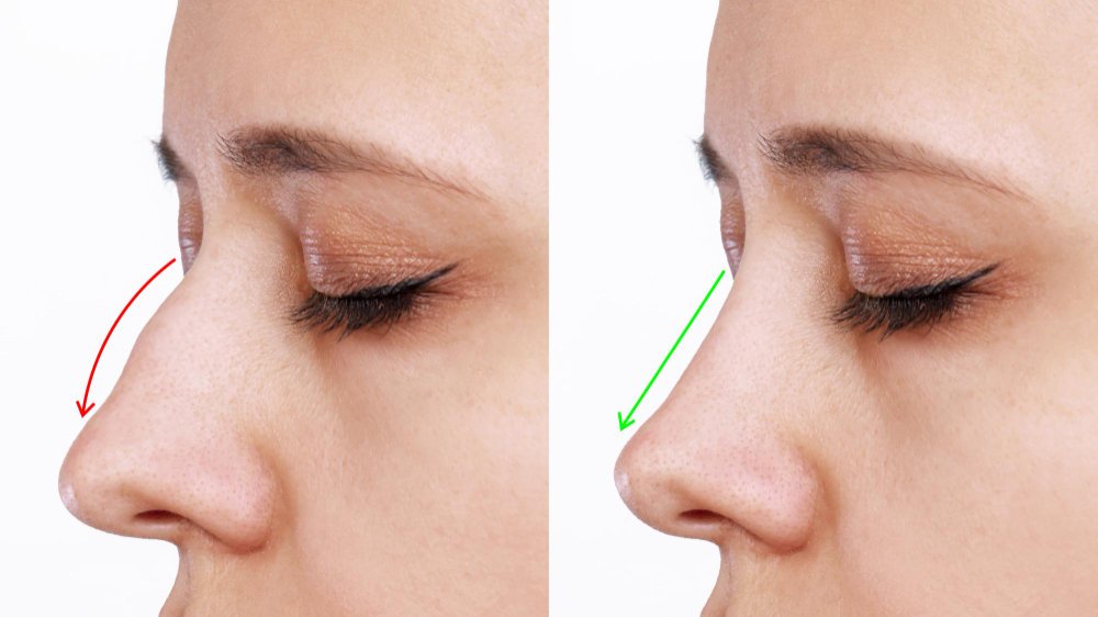 Открытая и закрытая ринопластика в клинике Cayra Clinic Анталья