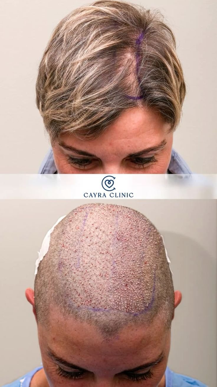 Пересадка волос для женщин в Турции без бритья — клиника Cayra Clinic